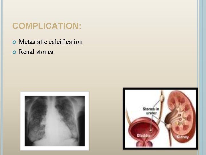 COMPLICATION: Metastatic calcification Renal stones 