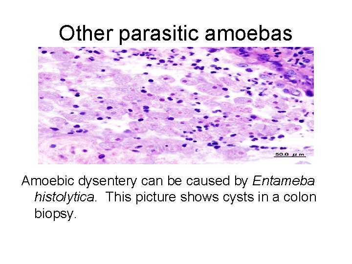 Other parasitic amoebas Amoebic dysentery can be caused by Entameba histolytica. This picture shows