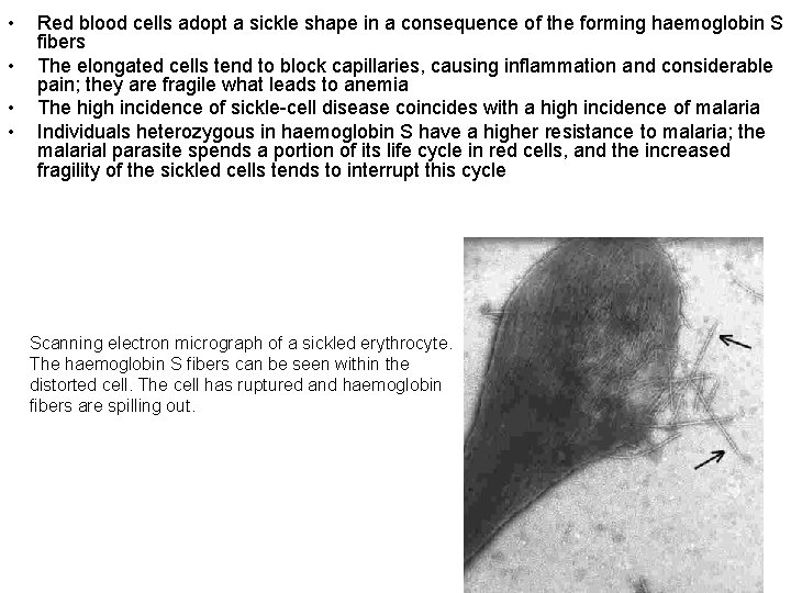  • • Red blood cells adopt a sickle shape in a consequence of