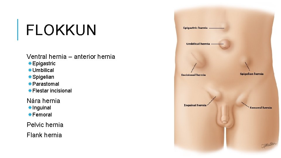FLOKKUN Ventral hernia – anterior hernia Epigastric Umbilical Spigelian Parastomal Flestar incisional Nára hernia