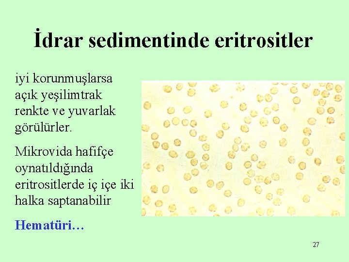 İdrar sedimentinde eritrositler iyi korunmuşlarsa açık yeşilimtrak renkte ve yuvarlak görülürler. Mikrovida hafifçe oynatıldığında