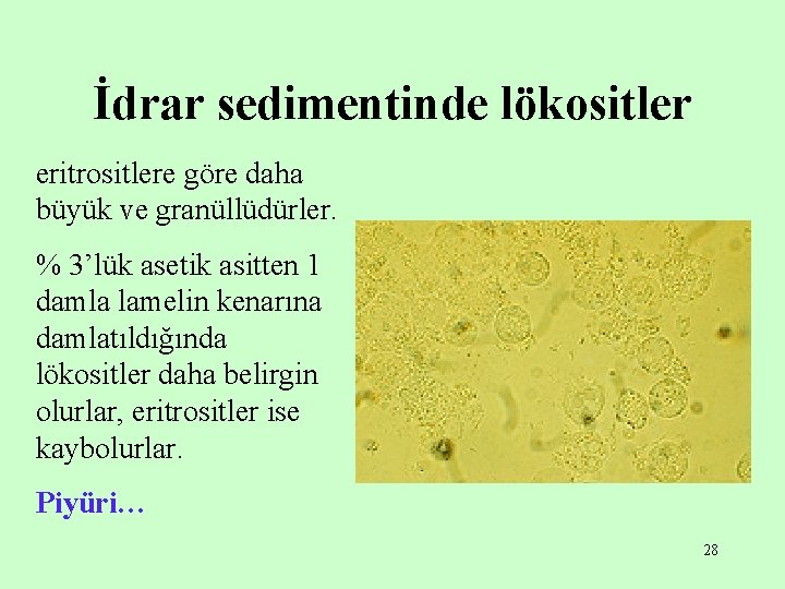İdrar sedimentinde lökositler eritrositlere göre daha büyük ve granüllüdürler. % 3’lük asetik asitten 1