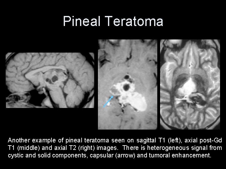 Pineal Teratoma Another example of pineal teratoma seen on sagittal T 1 (left), axial