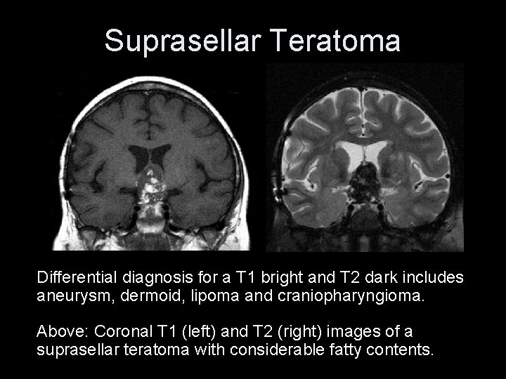 Suprasellar Teratoma Differential diagnosis for a T 1 bright and T 2 dark includes