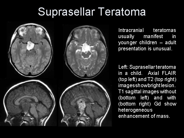 Suprasellar Teratoma Intracranial teratomas usually manifest in younger children – adult presentation is unusual.