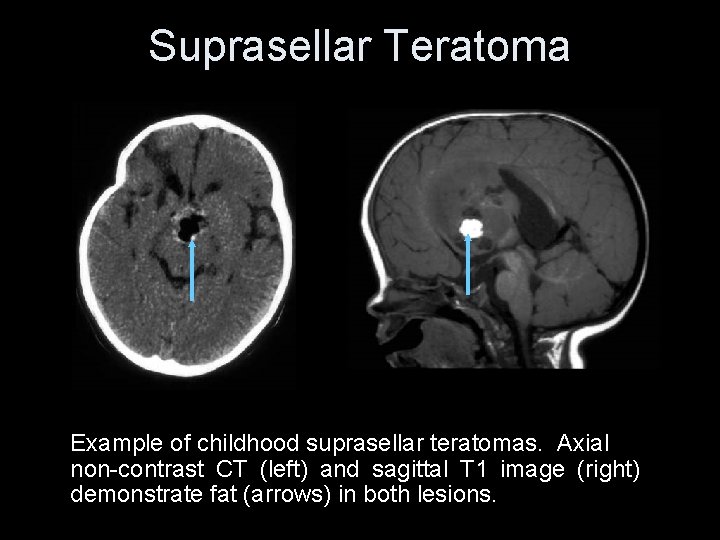 Suprasellar Teratoma Example of childhood suprasellar teratomas. Axial non-contrast CT (left) and sagittal T