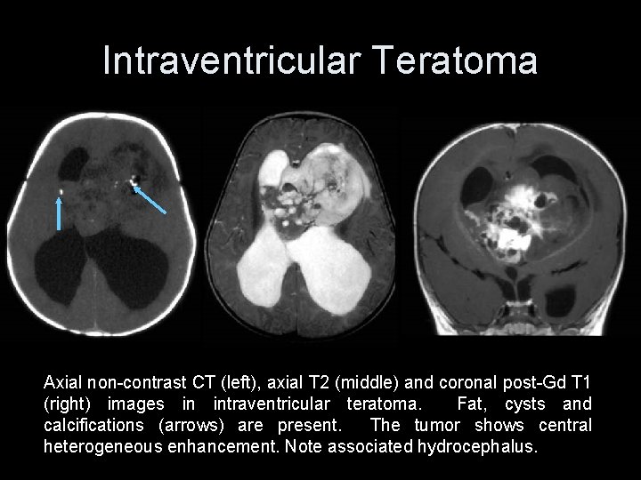 Intraventricular Teratoma Axial non-contrast CT (left), axial T 2 (middle) and coronal post-Gd T