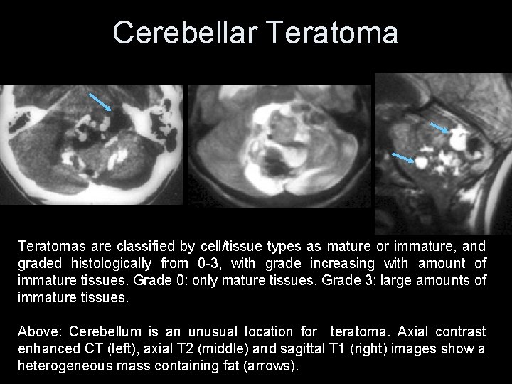 Cerebellar Teratomas are classified by cell/tissue types as mature or immature, and graded histologically