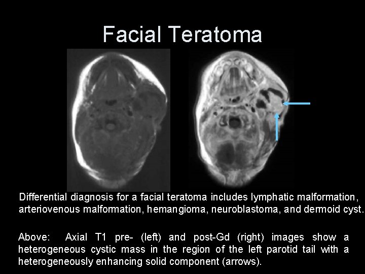 Facial Teratoma Differential diagnosis for a facial teratoma includes lymphatic malformation, arteriovenous malformation, hemangioma,