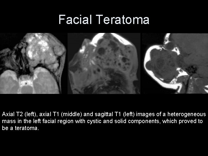 Facial Teratoma Axial T 2 (left), axial T 1 (middle) and sagittal T 1