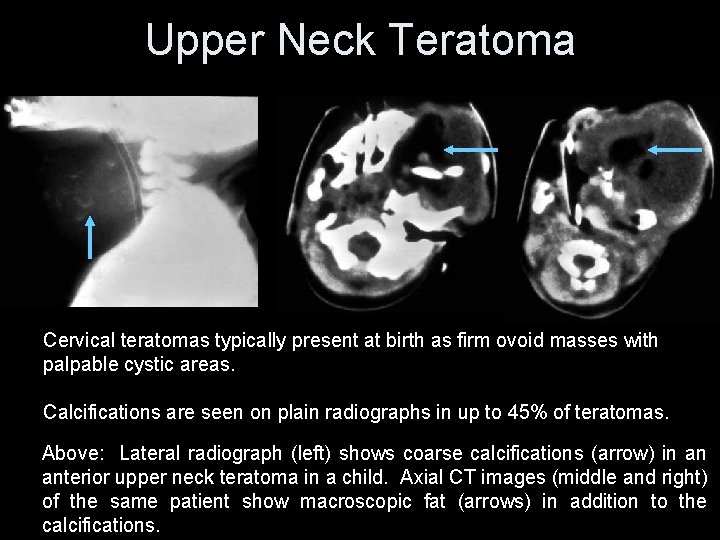 Upper Neck Teratoma Cervical teratomas typically present at birth as firm ovoid masses with