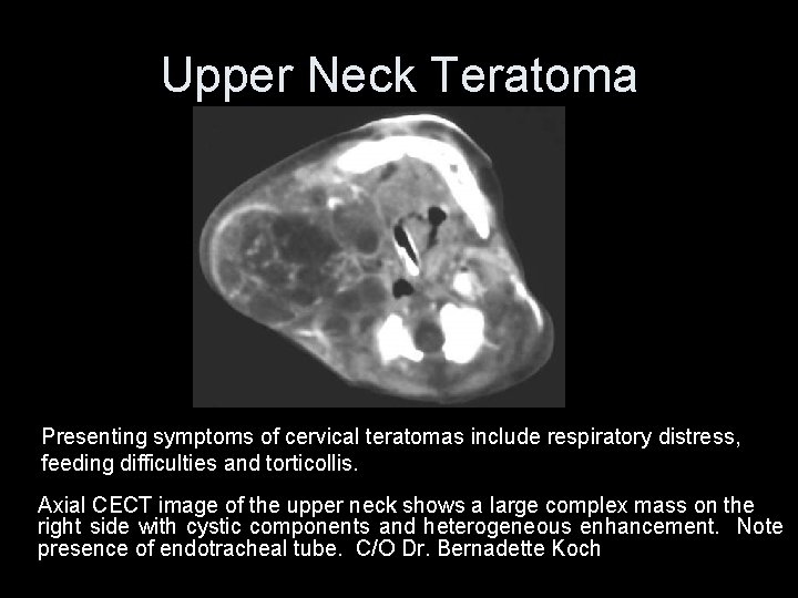 Upper Neck Teratoma Presenting symptoms of cervical teratomas include respiratory distress, feeding difficulties and