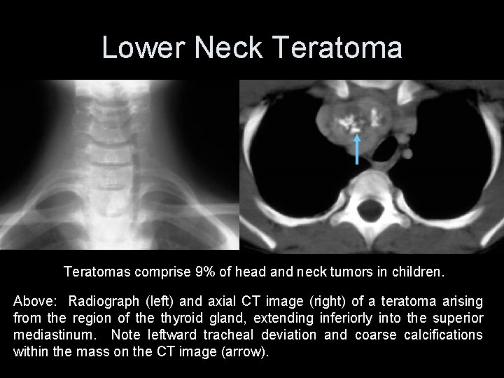 Lower Neck Teratomas comprise 9% of head and neck tumors in children. Above: Radiograph