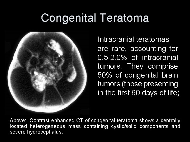 Congenital Teratoma Intracranial teratomas are rare, accounting for 0. 5 -2. 0% of intracranial