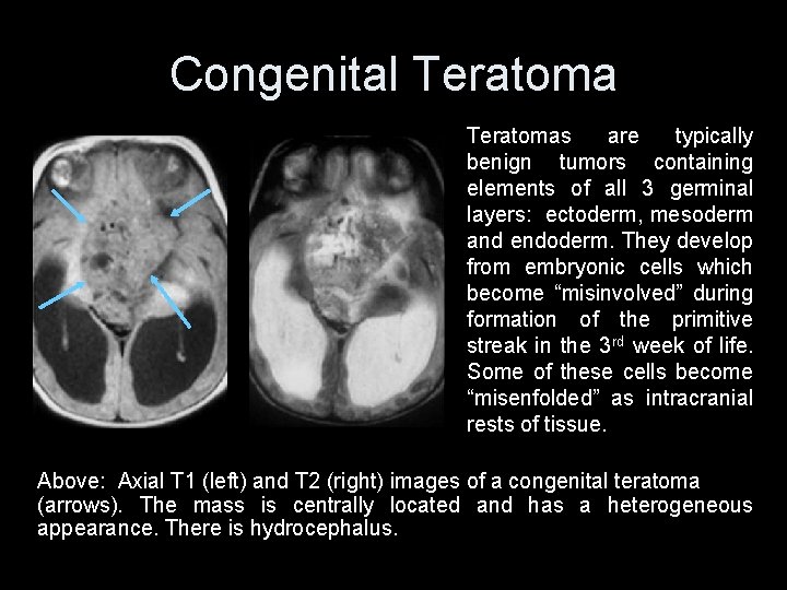 Congenital Teratomas are typically benign tumors containing elements of all 3 germinal layers: ectoderm,