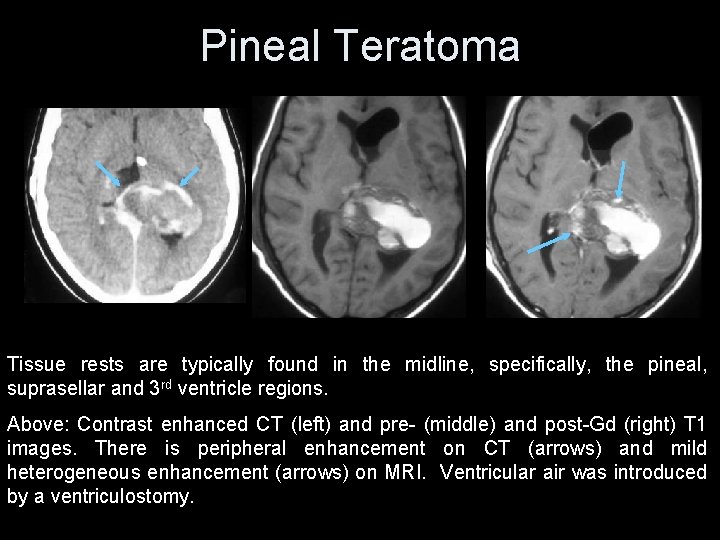 Pineal Teratoma Tissue rests are typically found in the midline, specifically, the pineal, suprasellar