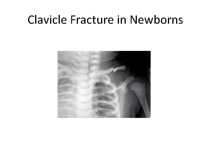 Clavicle Fracture in Newborns 