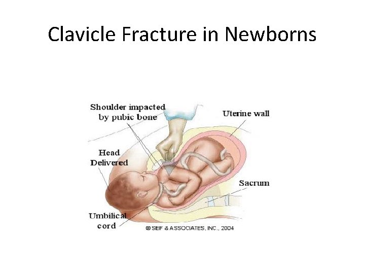 Clavicle Fracture in Newborns 