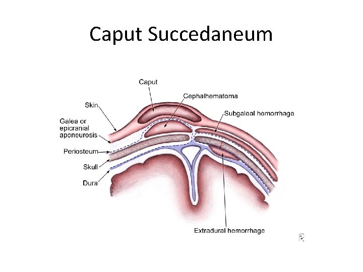 Caput Succedaneum 