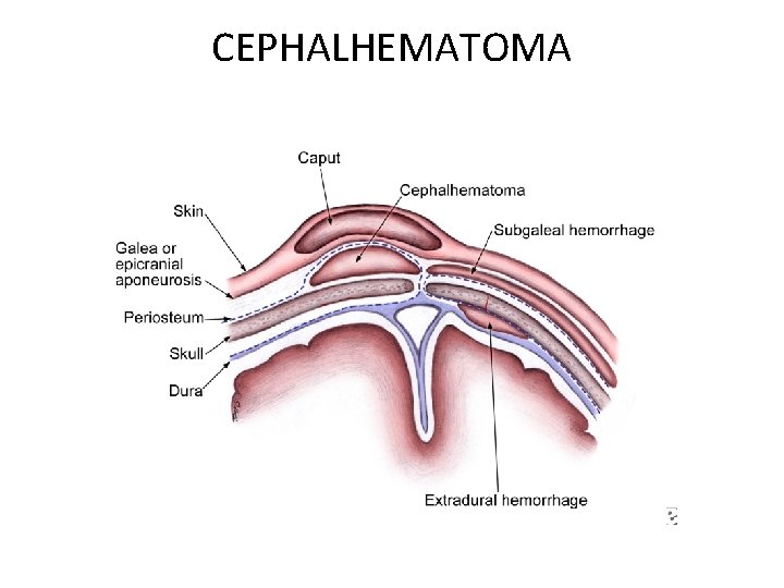 CEPHALHEMATOMA 