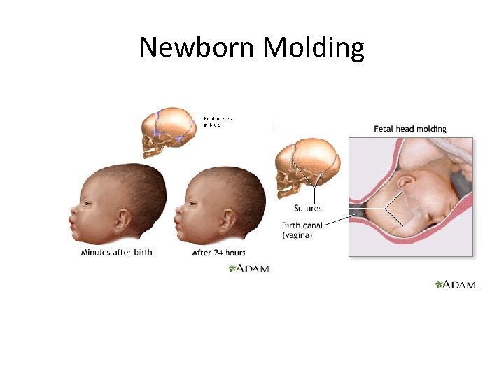 Newborn Molding 