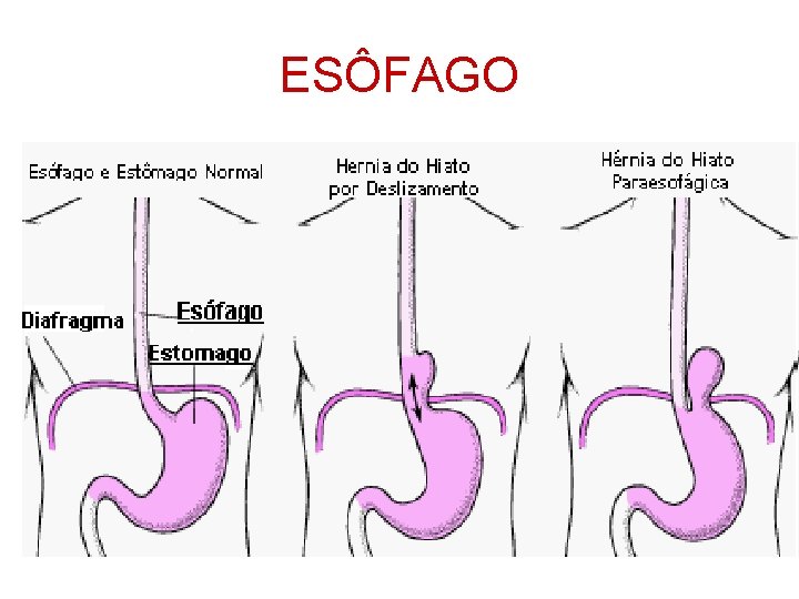 ESÔFAGO 