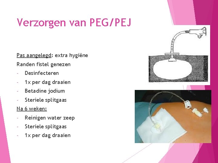 Verzorgen van PEG/PEJ Pas aangelegd: extra hygiëne Randen fistel genezen - Desinfecteren - 1
