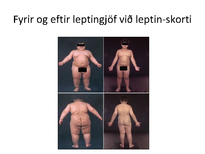 Fyrir og eftir leptingjöf við leptin-skorti 