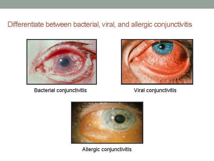 Differentiate between bacterial, viral, and allergic conjunctivitis Bacterial conjunctivitis Allergic conjunctivitis Viral conjunctivitis 