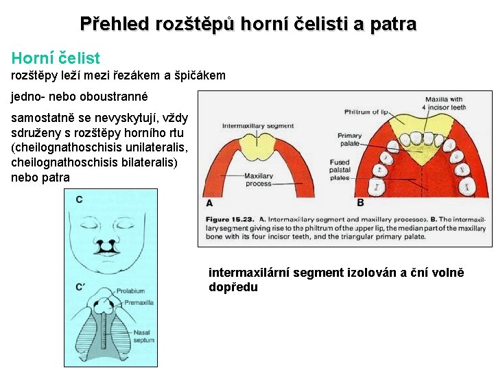 Přehled rozštěpů horní čelisti a patra Horní čelist rozštěpy leží mezi řezákem a špičákem