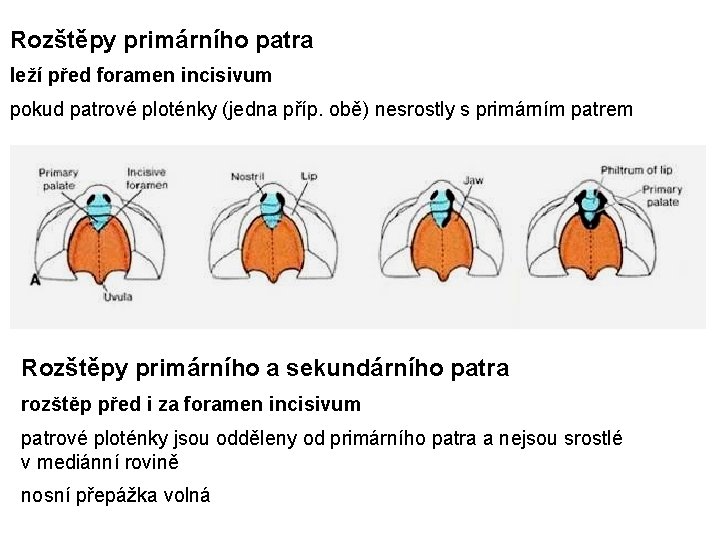 Rozštěpy primárního patra leží před foramen incisivum pokud patrové ploténky (jedna příp. obě) nesrostly