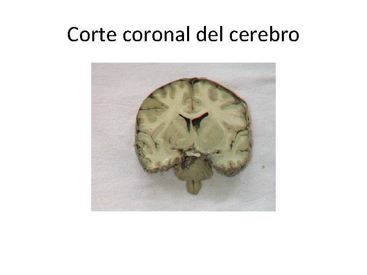 Corte coronal del cerebro 