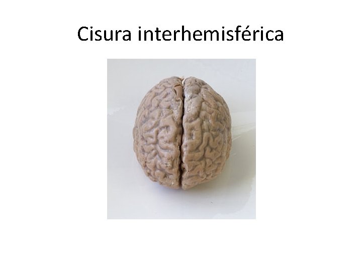 Cisura interhemisférica 