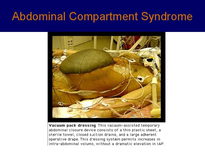 Abdominal Compartment Syndrome 