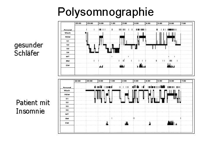 Polysomnographie gesunder Schläfer Patient mit Insomnie 