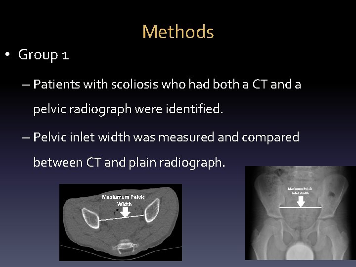 Methods • Group 1 – Patients with scoliosis who had both a CT and