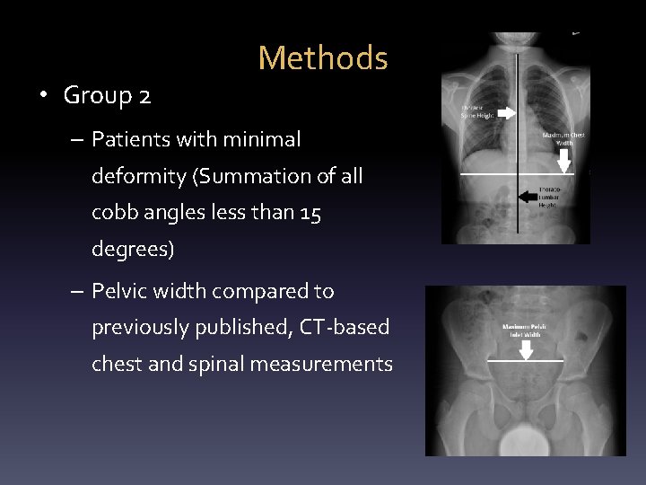  • Group 2 Methods – Patients with minimal deformity (Summation of all cobb