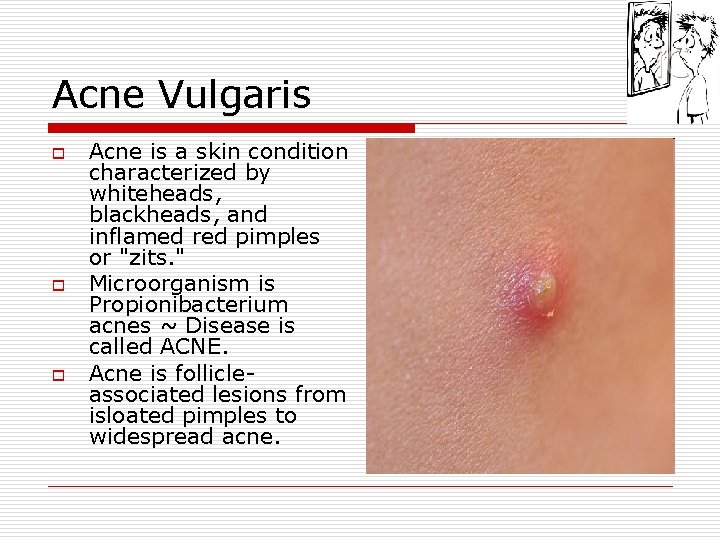 Acne Vulgaris o o o Acne is a skin condition characterized by whiteheads, blackheads,