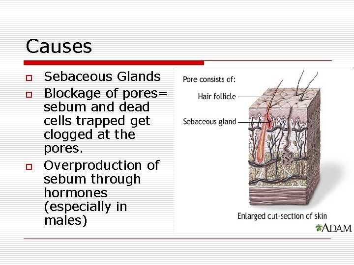 Causes o o o Sebaceous Glands Blockage of pores= sebum and dead cells trapped