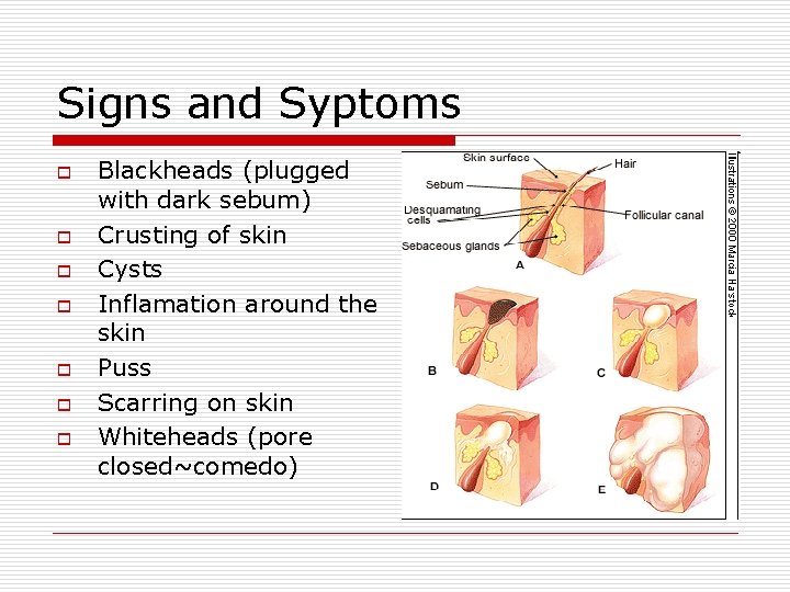 Signs and Syptoms o o o o Blackheads (plugged with dark sebum) Crusting of