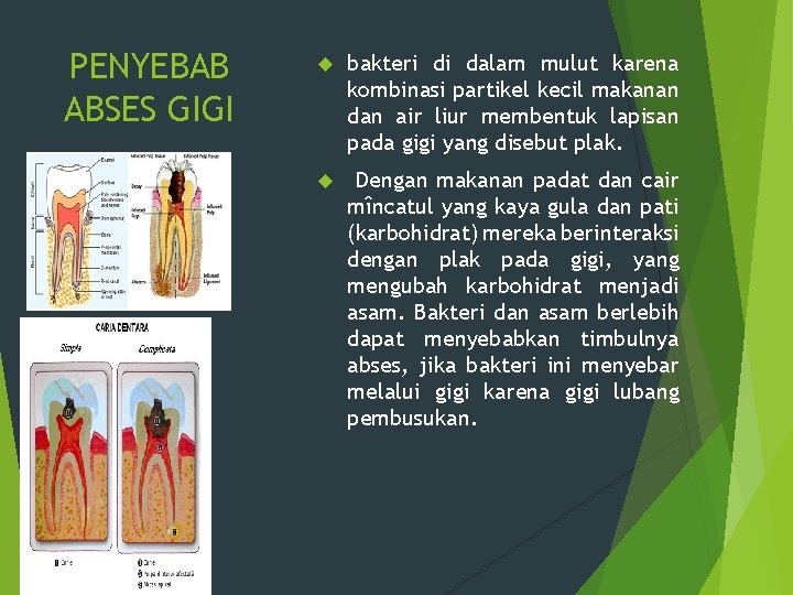 PENYEBAB ABSES GIGI bakteri di dalam mulut karena kombinasi partikel kecil makanan dan air