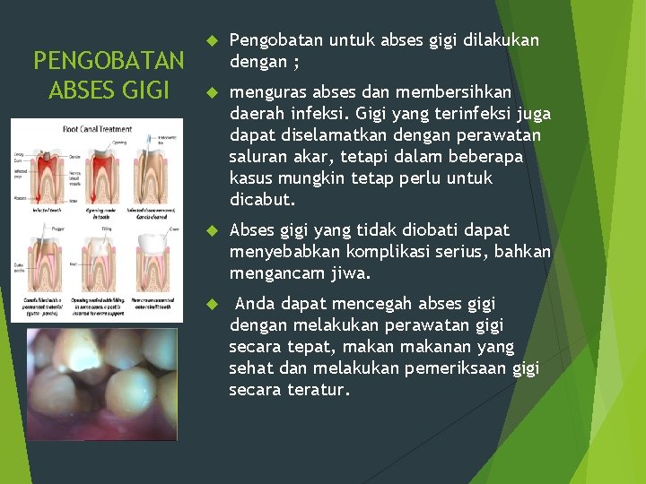 PENGOBATAN ABSES GIGI Pengobatan untuk abses gigi dilakukan dengan ; menguras abses dan membersihkan