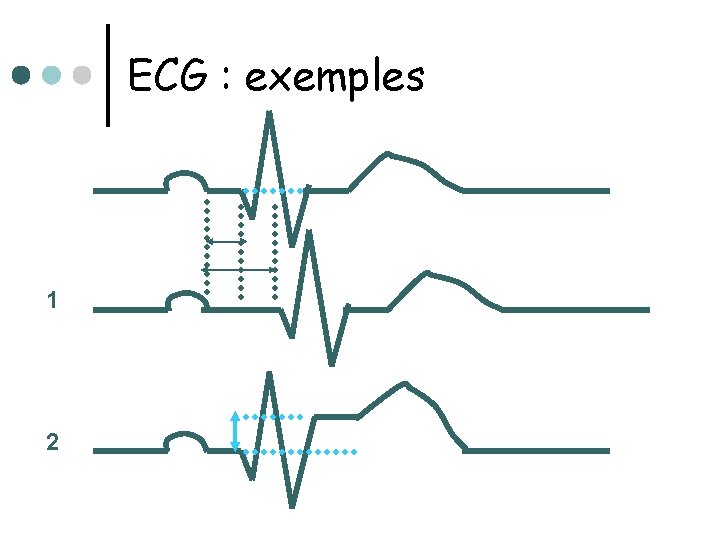 ECG : exemples 1 2 