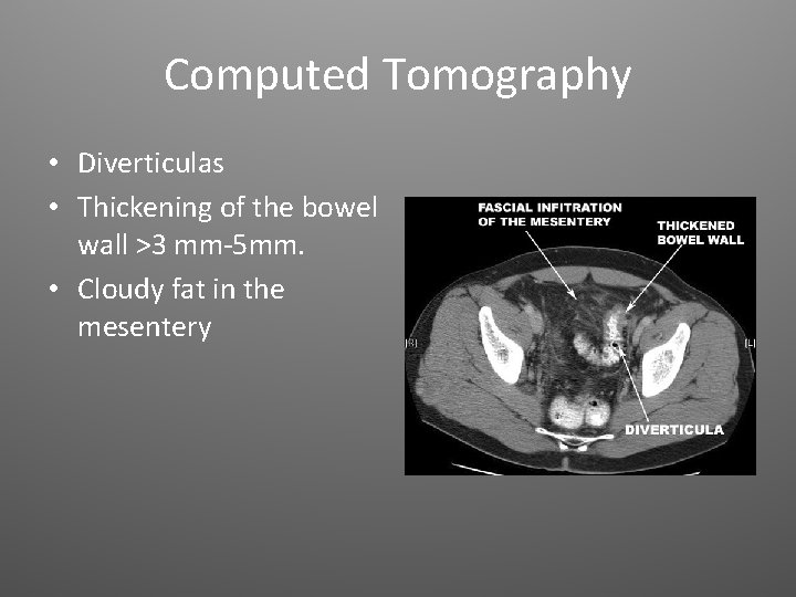 Computed Tomography • Diverticulas • Thickening of the bowel wall >3 mm-5 mm. •