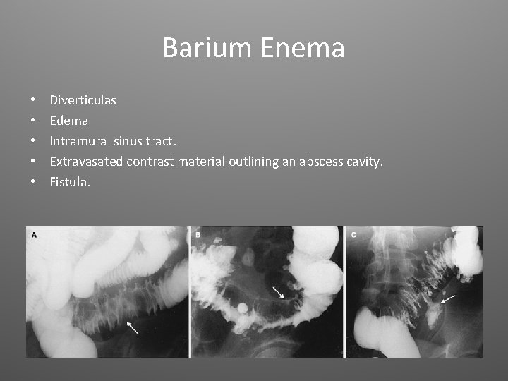 Barium Enema • • • Diverticulas Edema Intramural sinus tract. Extravasated contrast material outlining