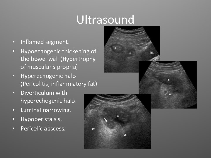 Ultrasound • Inflamed segment. • Hypoechogenic thickening of the bowel wall (Hypertrophy of muscularis