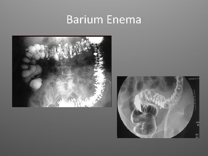 Barium Enema 