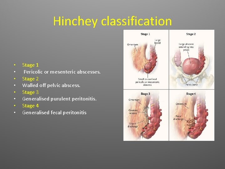 Hinchey classification • • Stage 1 Pericolic or mesenteric abscesses. Stage 2 Walled off