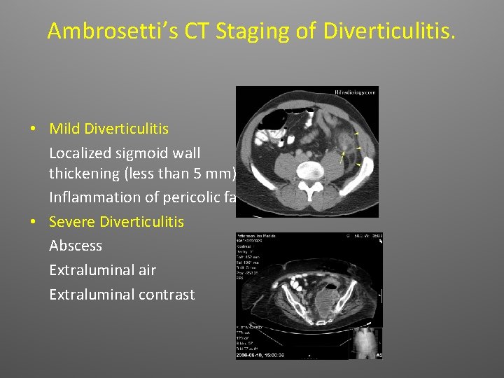Ambrosetti’s CT Staging of Diverticulitis. • Mild Diverticulitis Localized sigmoid wall thickening (less than
