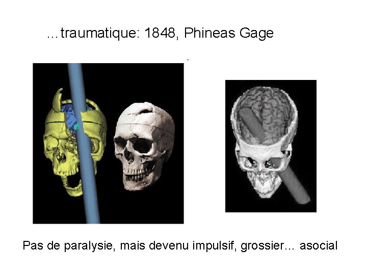 …traumatique: 1848, Phineas Gage Pas de paralysie, mais devenu impulsif, grossier… asocial 